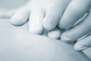 Trigger point dry needling Trigger point dry needling