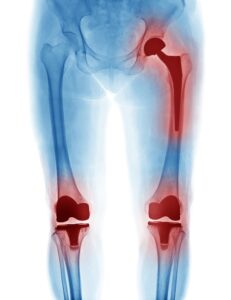 xray showing hips knees replacement
