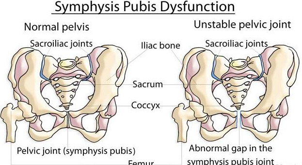 symphysis pubis dysfunction
