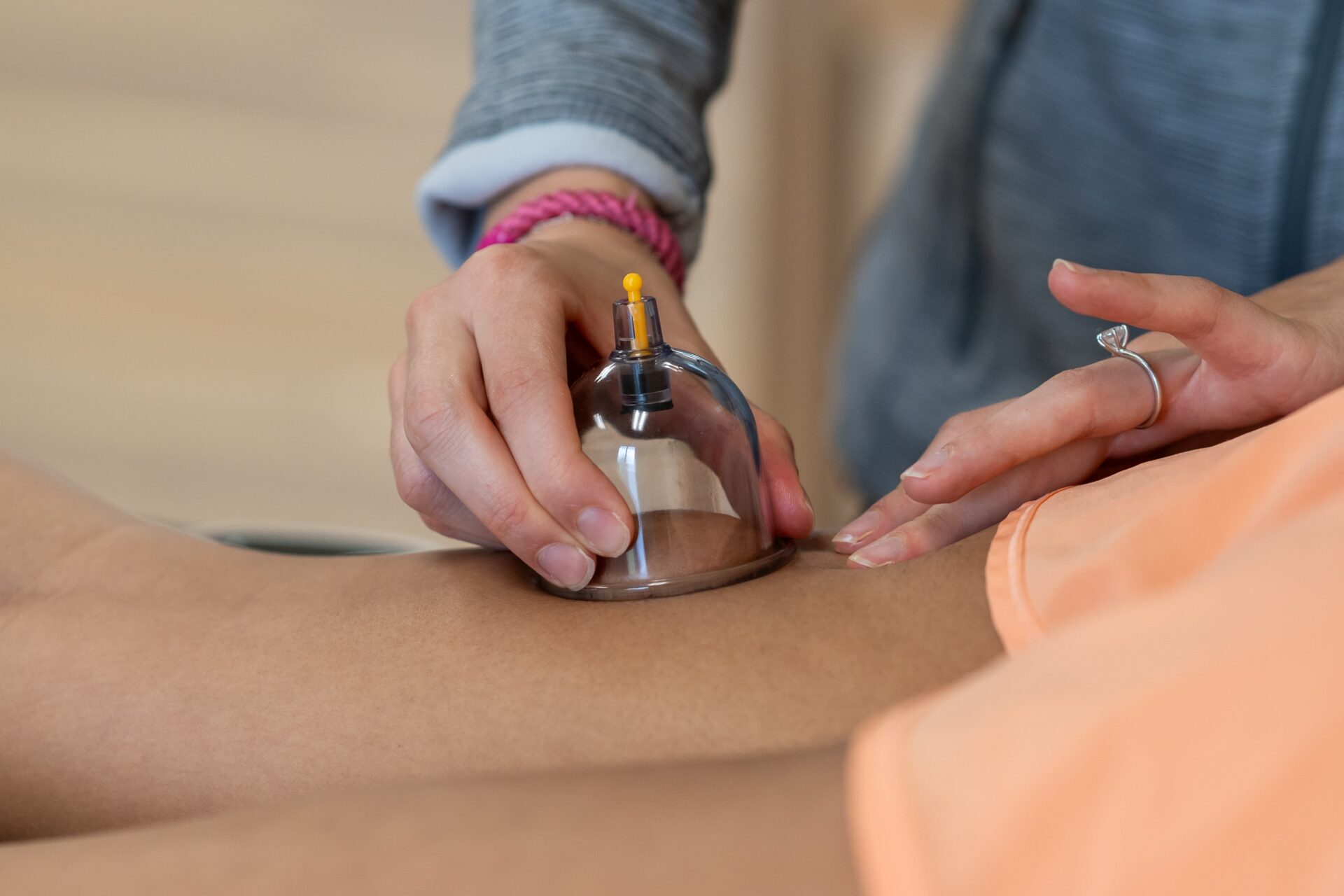 a woman getting cupping treatment at Aquacare